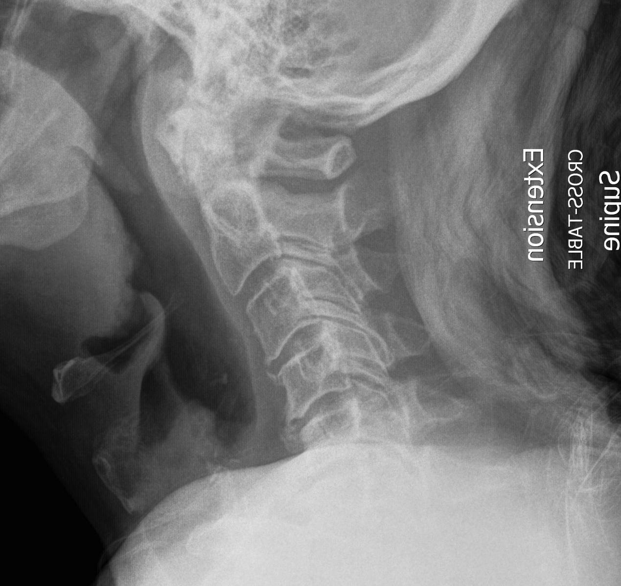 Cervical Myelopathy The Bone School